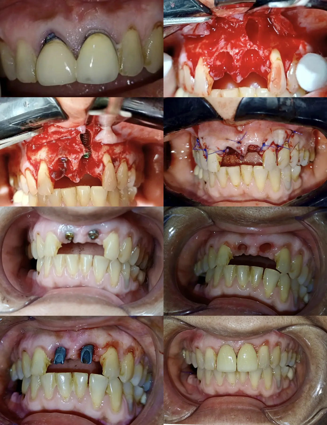Clinical sequence showing anterior implant and restorative treatment stages