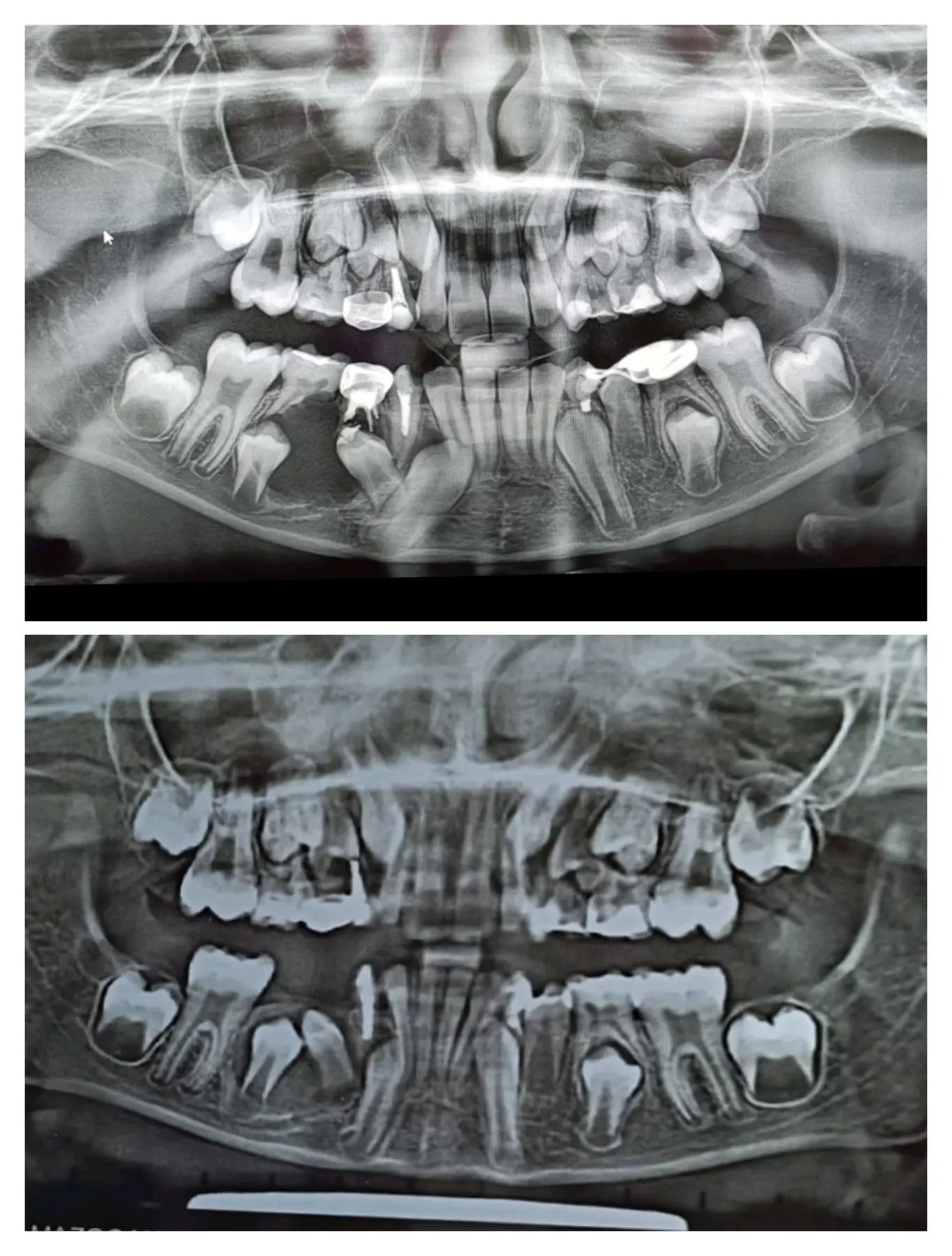 Two panoramic dental radiographs shown for clinical comparison