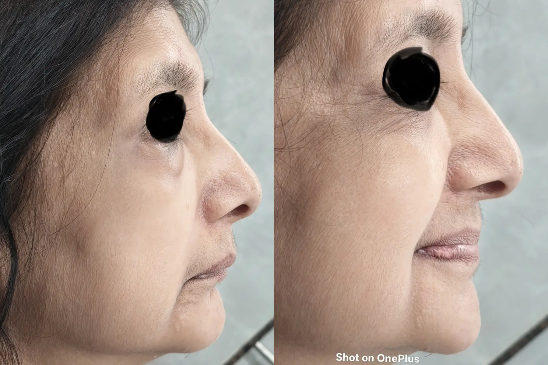 Two side-profile photographs used for facial and jaw assessment