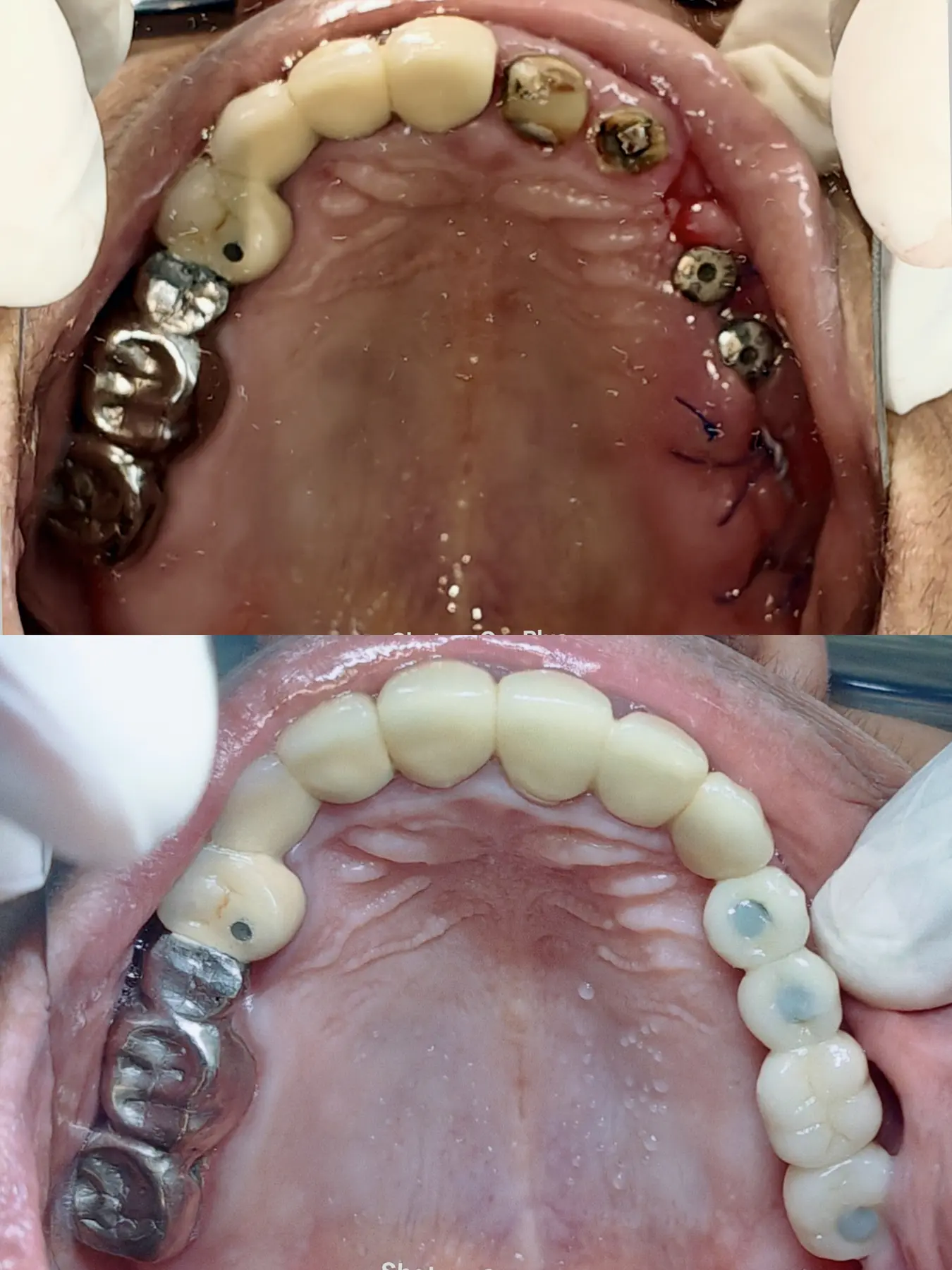Upper dental arch shown at the surgical stage and after restorative treatment