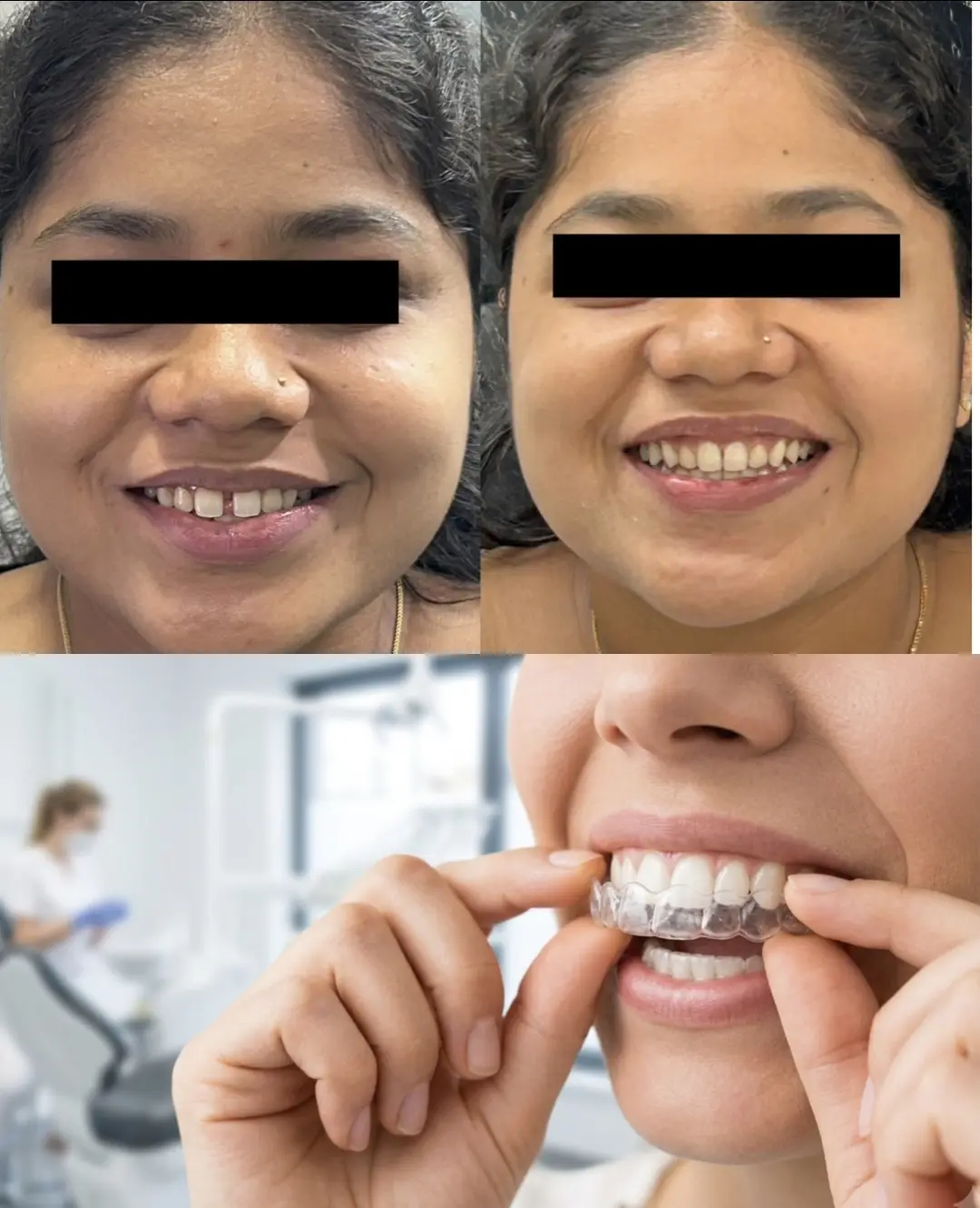 Before-and-after smile comparison with a clear Invisalign aligner shown below