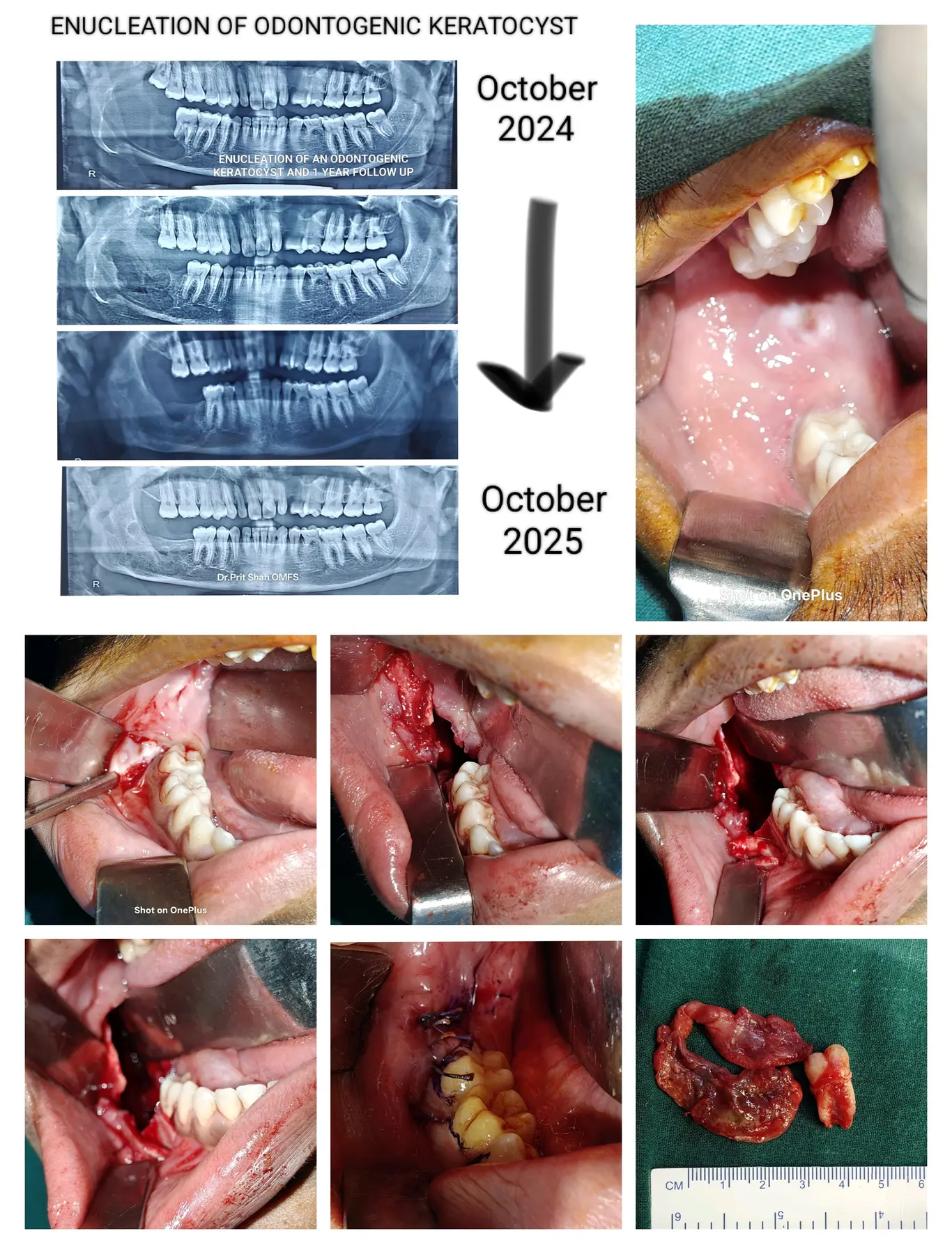 Radiographic and surgical case record for odontogenic keratocyst management